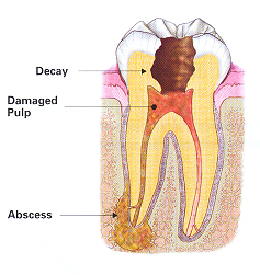 endodontic treatment image