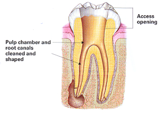 endodontic treatment image
