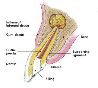 Tooth Saver: What's an Endodontist?